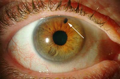 eye after Laser peripheral iridotomy